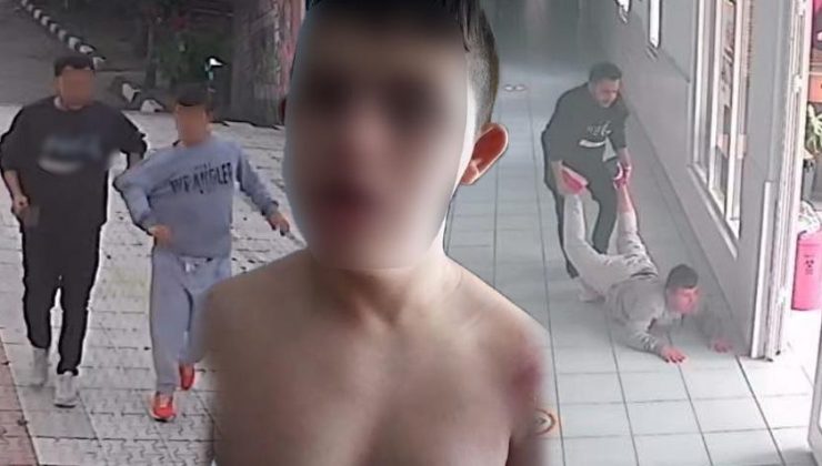 3 ay önce gözünde morlukla eve gelmişti! Öğretmenden down sendromlu öğrenciye darp iddiası