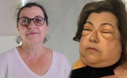 Dünyada 3, Türkiye’de ilk vaka! Yüzü tanınmaz hale geldi doktorun şüphesi doğru çıktı