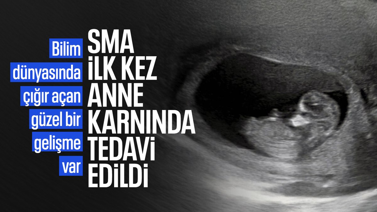 SMA’da dikkat çeken gelişme: İlk kez anne karnında tedavi edildi